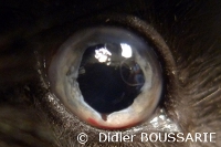Uvéite métaplasique cartilagineuse iris